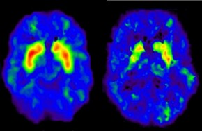 Stimulating the healthy and diseased brain